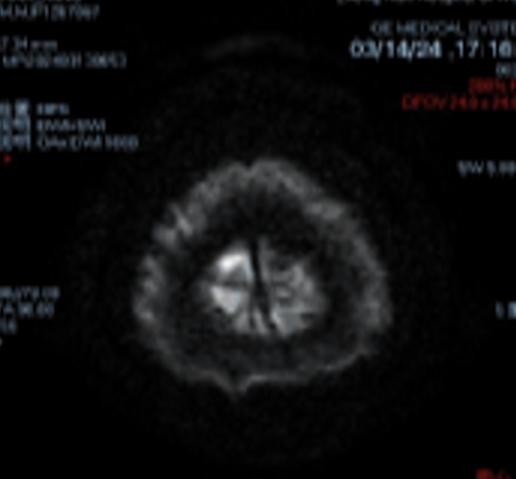 动脉长鞘怎么置入桡路大腔，超薄无伤 ｜ EasyMax™ Pro长鞘经桡入路辅助行颈内动脉支架植入术_https://www.jmylbn.com_新闻资讯_第4张