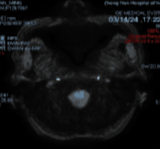 动脉长鞘怎么置入桡路大腔，超薄无伤 ｜ EasyMax™ Pro长鞘经桡入路辅助行颈内动脉支架植入术_https://www.jmylbn.com_新闻资讯_第5张