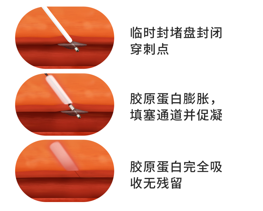 稳合器是什么“风口已至”｜SWIFT™血管封合器：一型适配动静脉， 高效止血稳准快！_https://www.jmylbn.com_新闻资讯_第2张