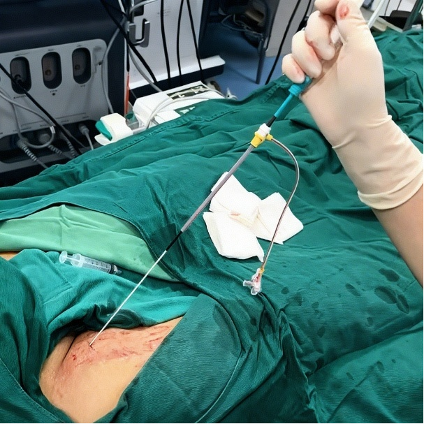 稳合器是什么“风口已至”｜SWIFT™血管封合器：一型适配动静脉， 高效止血稳准快！_https://www.jmylbn.com_新闻资讯_第8张