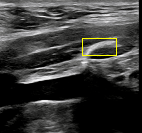 稳合器是什么“风口已至”｜SWIFT™血管封合器：一型适配动静脉， 高效止血稳准快！_https://www.jmylbn.com_新闻资讯_第6张