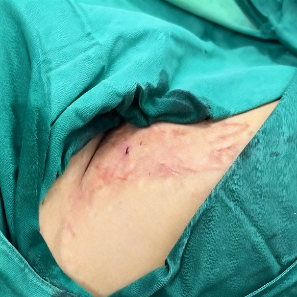 稳合器是什么“风口已至”｜SWIFT™血管封合器：一型适配动静脉， 高效止血稳准快！_https://www.jmylbn.com_新闻资讯_第9张