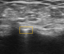稳合器是什么“风口已至”｜SWIFT™血管封合器：一型适配动静脉， 高效止血稳准快！_https://www.jmylbn.com_新闻资讯_第5张