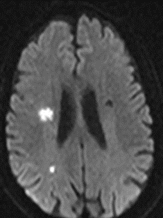 导丝怎么扩【载药时代 球扩天下】NOVA DES®颅内药物洗脱支架在颈内动脉颅内段重度狭窄的应用二例！_https://www.jmylbn.com_新闻资讯_第4张