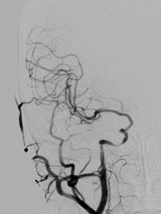 导丝怎么扩【载药时代 球扩天下】NOVA DES®颅内药物洗脱支架在颈内动脉颅内段重度狭窄的应用二例！_https://www.jmylbn.com_新闻资讯_第6张