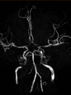 导丝怎么扩【载药时代 球扩天下】NOVA DES®颅内药物洗脱支架在颈内动脉颅内段重度狭窄的应用二例！_https://www.jmylbn.com_新闻资讯_第5张