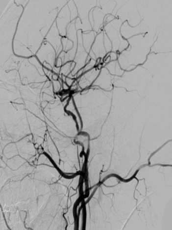 导丝怎么扩【载药时代 球扩天下】NOVA DES®颅内药物洗脱支架在颈内动脉颅内段重度狭窄的应用二例！_https://www.jmylbn.com_新闻资讯_第7张