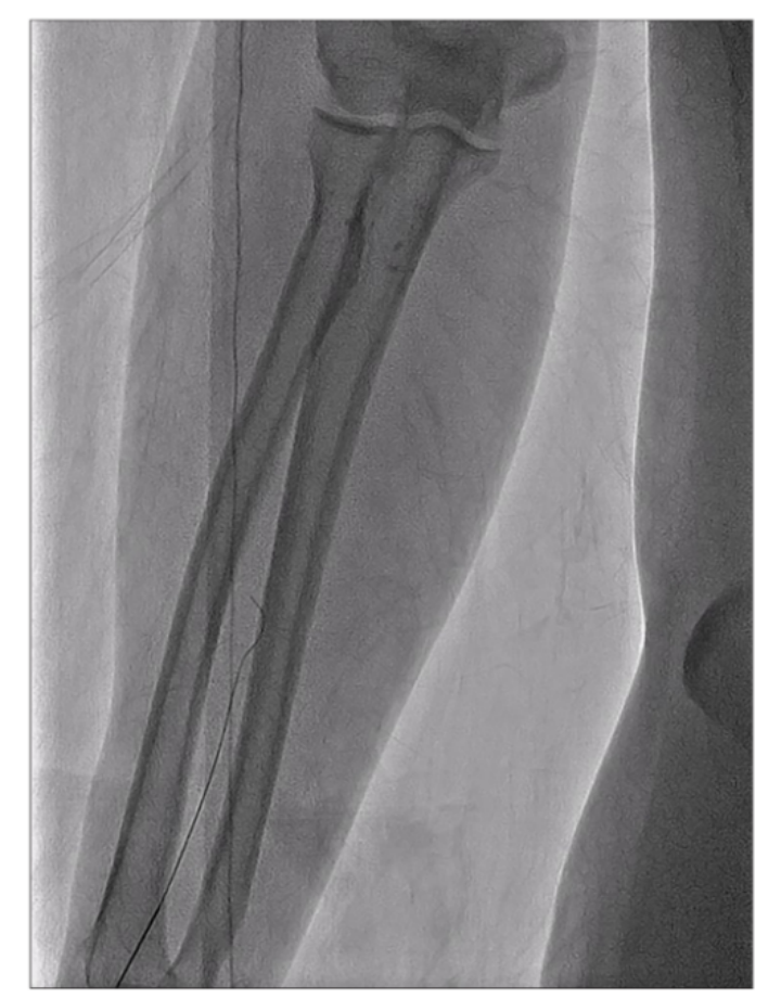 桡动脉鞘怎么读【CNIT专栏】经桡动脉脑血管造影中减少桡动脉闭塞：来自543例患者的单中心研究的关键预测因素和预防措施_https://www.jmylbn.com_新闻资讯_第2张