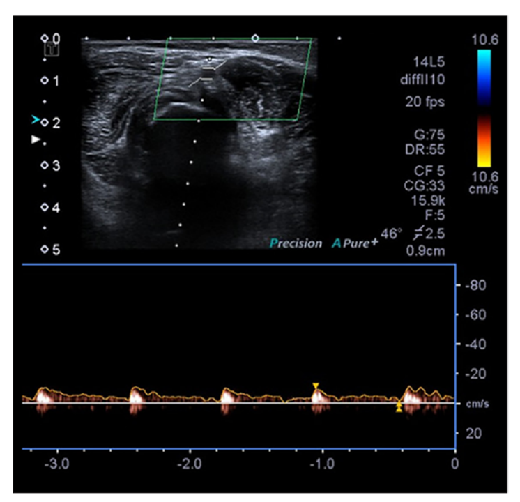 桡动脉鞘怎么读【CNIT专栏】经桡动脉脑血管造影中减少桡动脉闭塞：来自543例患者的单中心研究的关键预测因素和预防措施_https://www.jmylbn.com_新闻资讯_第4张