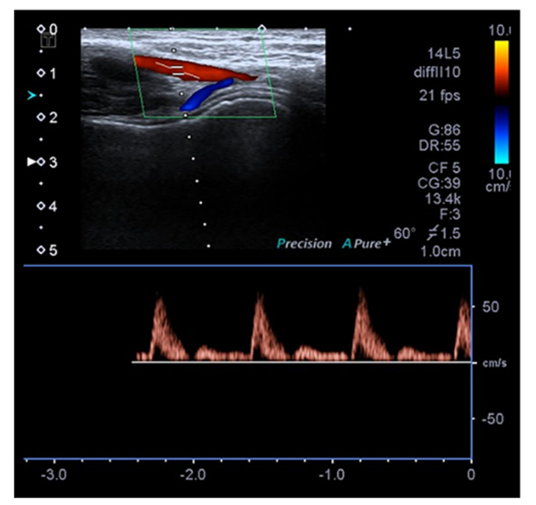 桡动脉鞘怎么读【CNIT专栏】经桡动脉脑血管造影中减少桡动脉闭塞：来自543例患者的单中心研究的关键预测因素和预防措施_https://www.jmylbn.com_新闻资讯_第5张