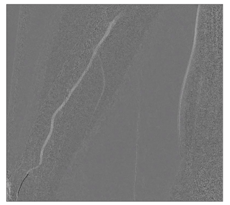 桡动脉鞘怎么读【CNIT专栏】经桡动脉脑血管造影中减少桡动脉闭塞：来自543例患者的单中心研究的关键预测因素和预防措施_https://www.jmylbn.com_新闻资讯_第3张