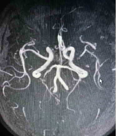 导丝怎么扩【载药时代 球扩天下】NOVA DES®颅内药物洗脱支架在大脑中动脉重度狭窄中的应用两例！_https://www.jmylbn.com_新闻资讯_第15张