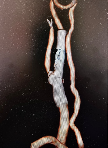 导丝怎么扩【载药时代 球扩天下】NOVA DES®颅内药物洗脱支架在大脑中动脉重度狭窄中的应用两例！_https://www.jmylbn.com_新闻资讯_第8张