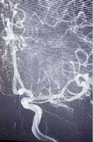 导丝怎么扩【载药时代 球扩天下】NOVA DES®颅内药物洗脱支架在大脑中动脉重度狭窄中的应用两例！_https://www.jmylbn.com_新闻资讯_第20张