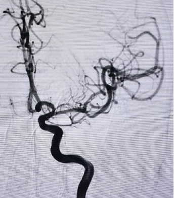 导丝怎么扩【载药时代 球扩天下】NOVA DES®颅内药物洗脱支架在大脑中动脉重度狭窄中的应用两例！_https://www.jmylbn.com_新闻资讯_第22张