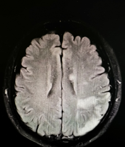 导丝怎么扩【载药时代 球扩天下】NOVA DES®颅内药物洗脱支架在大脑中动脉重度狭窄中的应用两例！_https://www.jmylbn.com_新闻资讯_第14张