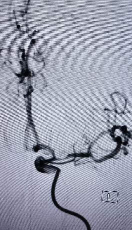 导丝怎么扩【载药时代 球扩天下】NOVA DES®颅内药物洗脱支架在大脑中动脉重度狭窄中的应用两例！_https://www.jmylbn.com_新闻资讯_第17张