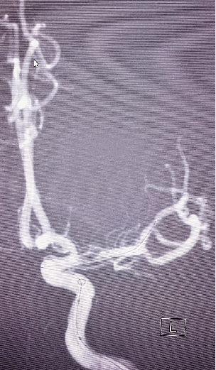 导丝怎么扩【载药时代 球扩天下】NOVA DES®颅内药物洗脱支架在大脑中动脉重度狭窄中的应用两例！_https://www.jmylbn.com_新闻资讯_第18张