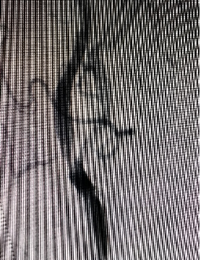 导丝怎么扩【载药时代 球扩天下】NOVA DES®颅内药物洗脱支架在大脑中动脉重度狭窄中的应用两例！_https://www.jmylbn.com_新闻资讯_第5张