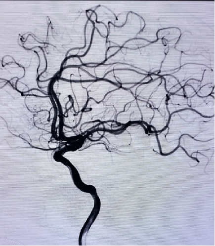 导丝怎么扩【载药时代 球扩天下】NOVA DES®颅内药物洗脱支架在大脑中动脉重度狭窄中的应用两例！_https://www.jmylbn.com_新闻资讯_第23张