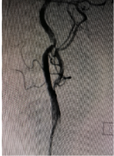 导丝怎么扩【载药时代 球扩天下】NOVA DES®颅内药物洗脱支架在大脑中动脉重度狭窄中的应用两例！_https://www.jmylbn.com_新闻资讯_第7张