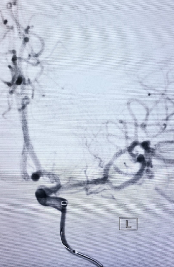 导丝怎么扩【载药时代 球扩天下】NOVA DES®颅内药物洗脱支架在大脑中动脉重度狭窄中的应用两例！_https://www.jmylbn.com_新闻资讯_第21张
