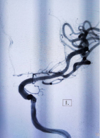 导丝怎么扩【载药时代 球扩天下】NOVA DES®颅内药物洗脱支架在大脑中动脉重度狭窄中的应用两例！_https://www.jmylbn.com_新闻资讯_第11张