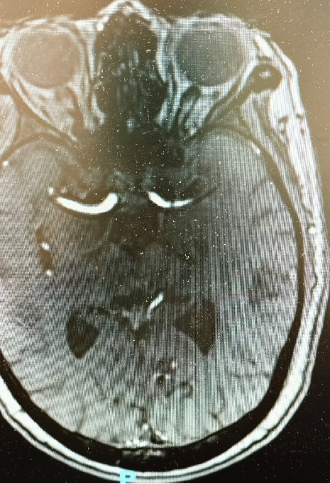 导丝怎么扩【载药时代 球扩天下】NOVA DES®颅内药物洗脱支架在大脑中动脉重度狭窄中的应用两例！_https://www.jmylbn.com_新闻资讯_第3张