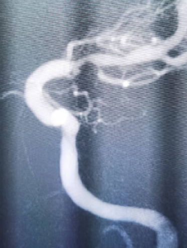 导丝怎么扩【载药时代 球扩天下】NOVA DES®颅内药物洗脱支架在大脑中动脉重度狭窄中的应用两例！_https://www.jmylbn.com_新闻资讯_第9张