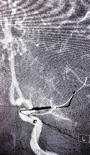 导丝怎么扩【载药时代 球扩天下】NOVA DES®颅内药物洗脱支架在大脑中动脉重度狭窄中的应用两例！_https://www.jmylbn.com_新闻资讯_第19张