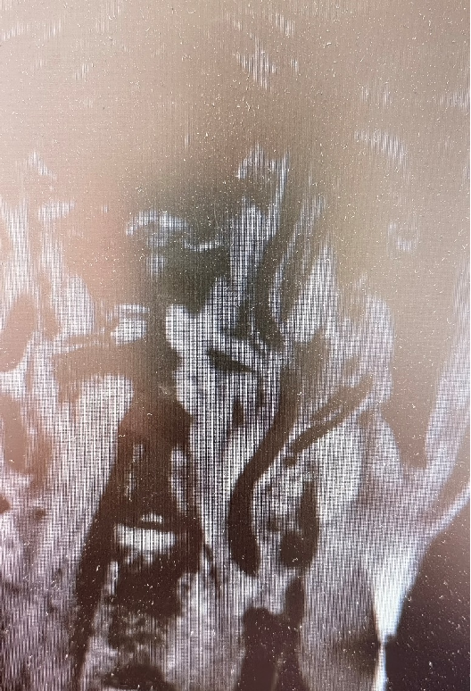 导丝怎么扩【载药时代 球扩天下】NOVA DES®颅内药物洗脱支架在大脑中动脉重度狭窄中的应用两例！_https://www.jmylbn.com_新闻资讯_第4张