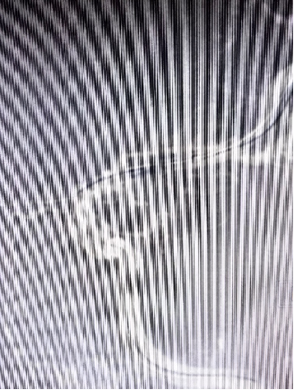 导丝怎么扩【载药时代 球扩天下】NOVA DES®颅内药物洗脱支架在大脑中动脉重度狭窄中的应用两例！_https://www.jmylbn.com_新闻资讯_第10张