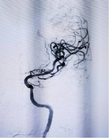 导丝怎么扩【载药时代 球扩天下】NOVA DES®颅内药物洗脱支架在大脑中动脉重度狭窄中的应用两例！_https://www.jmylbn.com_新闻资讯_第12张