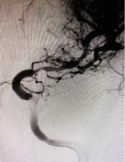 导丝怎么扩【载药时代 球扩天下】NOVA DES®颅内药物洗脱支架在大脑中动脉重度狭窄中的应用两例！_https://www.jmylbn.com_新闻资讯_第6张