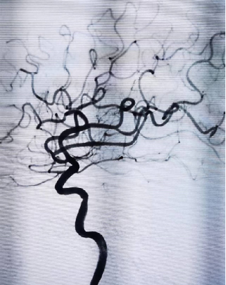 导丝怎么扩【载药时代 球扩天下】NOVA DES®颅内药物洗脱支架在大脑中动脉重度狭窄中的应用两例！_https://www.jmylbn.com_新闻资讯_第13张