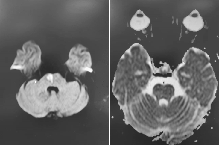 导丝怎么扩【载药时代 球扩天下】NOVA DES®颅内药物洗脱支架在椎动脉颅内段重度狭窄的应用二例_https://www.jmylbn.com_新闻资讯_第8张