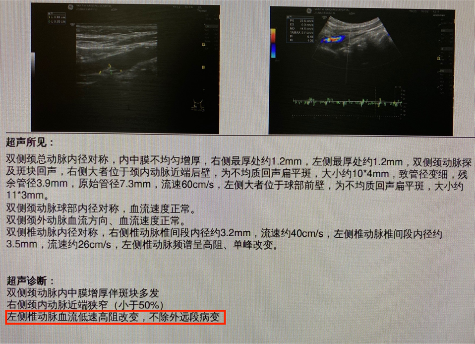 导丝怎么扩【载药时代 球扩天下】NOVA DES®颅内药物洗脱支架在椎动脉颅内段重度狭窄的应用二例_https://www.jmylbn.com_新闻资讯_第19张
