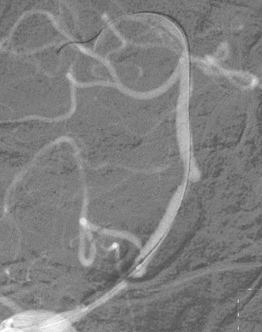 导丝怎么扩【载药时代 球扩天下】NOVA DES®颅内药物洗脱支架在椎动脉颅内段重度狭窄的应用二例_https://www.jmylbn.com_新闻资讯_第14张