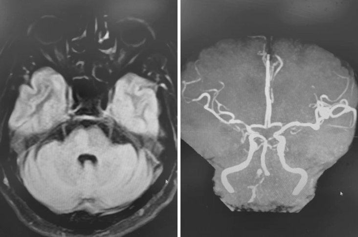 导丝怎么扩【载药时代 球扩天下】NOVA DES®颅内药物洗脱支架在椎动脉颅内段重度狭窄的应用二例_https://www.jmylbn.com_新闻资讯_第9张