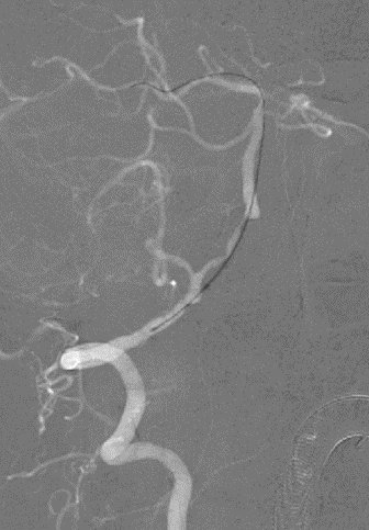 导丝怎么扩【载药时代 球扩天下】NOVA DES®颅内药物洗脱支架在椎动脉颅内段重度狭窄的应用二例_https://www.jmylbn.com_新闻资讯_第10张