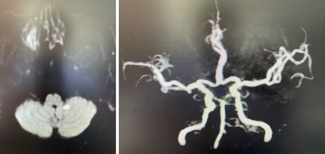 导丝怎么扩【载药时代 球扩天下】NOVA DES®颅内药物洗脱支架在椎动脉颅内段重度狭窄的应用二例_https://www.jmylbn.com_新闻资讯_第20张