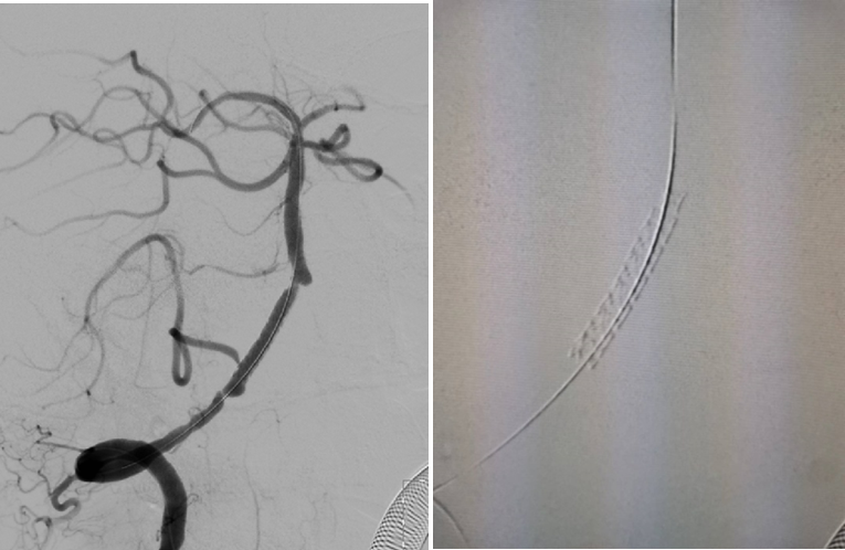 导丝怎么扩【载药时代 球扩天下】NOVA DES®颅内药物洗脱支架在椎动脉颅内段重度狭窄的应用二例_https://www.jmylbn.com_新闻资讯_第13张