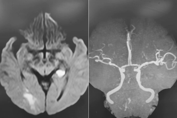 导丝怎么扩【载药时代 球扩天下】NOVA DES®颅内药物洗脱支架在椎动脉颅内段重度狭窄的应用二例_https://www.jmylbn.com_新闻资讯_第5张