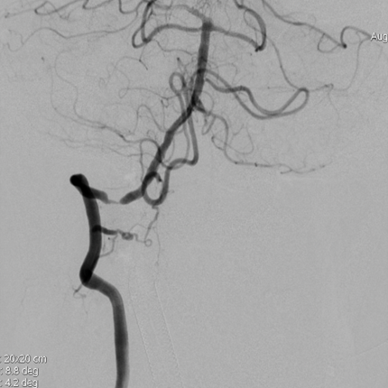 导丝怎么扩【载药时代 球扩天下】NOVA DES®颅内药物洗脱支架在椎动脉颅内段重度狭窄的应用二例_https://www.jmylbn.com_新闻资讯_第31张