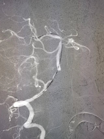 导丝怎么扩【载药时代 球扩天下】NOVA DES®颅内药物洗脱支架在椎动脉颅内段重度狭窄的应用二例_https://www.jmylbn.com_新闻资讯_第11张