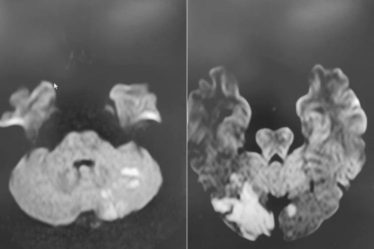 导丝怎么扩【载药时代 球扩天下】NOVA DES®颅内药物洗脱支架在椎动脉颅内段重度狭窄的应用二例_https://www.jmylbn.com_新闻资讯_第4张