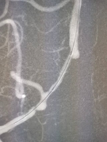 导丝怎么扩【载药时代 球扩天下】NOVA DES®颅内药物洗脱支架在椎动脉颅内段重度狭窄的应用二例_https://www.jmylbn.com_新闻资讯_第12张