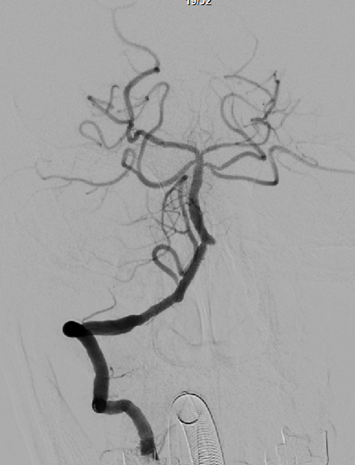 导丝怎么扩【载药时代 球扩天下】NOVA DES®颅内药物洗脱支架在椎动脉颅内段重度狭窄的应用二例_https://www.jmylbn.com_新闻资讯_第15张
