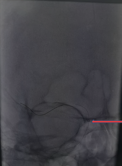 导丝怎么扩【载药时代 球扩天下】NOVA DES®颅内药物洗脱支架在颈内动脉颅内段重度狭窄的应用两例！滕州市中心医院&山西医科大学第二医院_https://www.jmylbn.com_新闻资讯_第19张