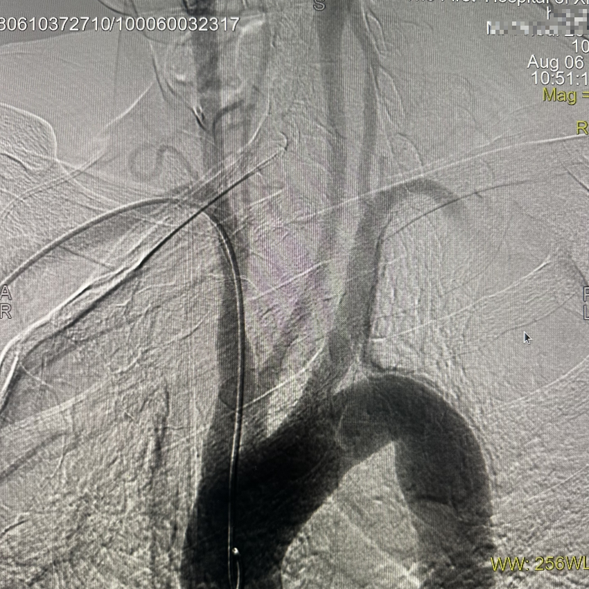 动脉长鞘怎么置入一技之“长”丨经桡及经股困难入路应用赛诺神畅APEX TRA GC™导引导管建立通路病例合集_https://www.jmylbn.com_新闻资讯_第20张